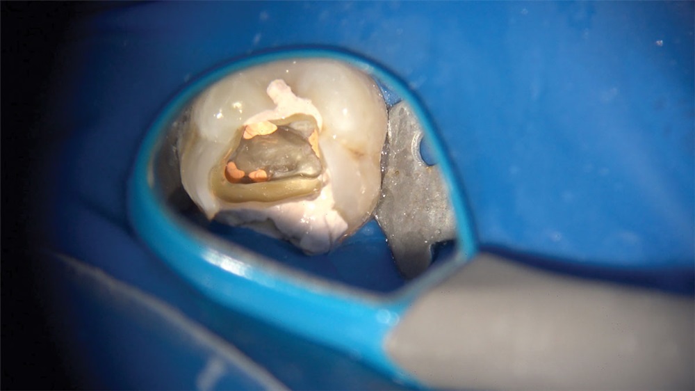 File Delivery for Endodontic Treatment