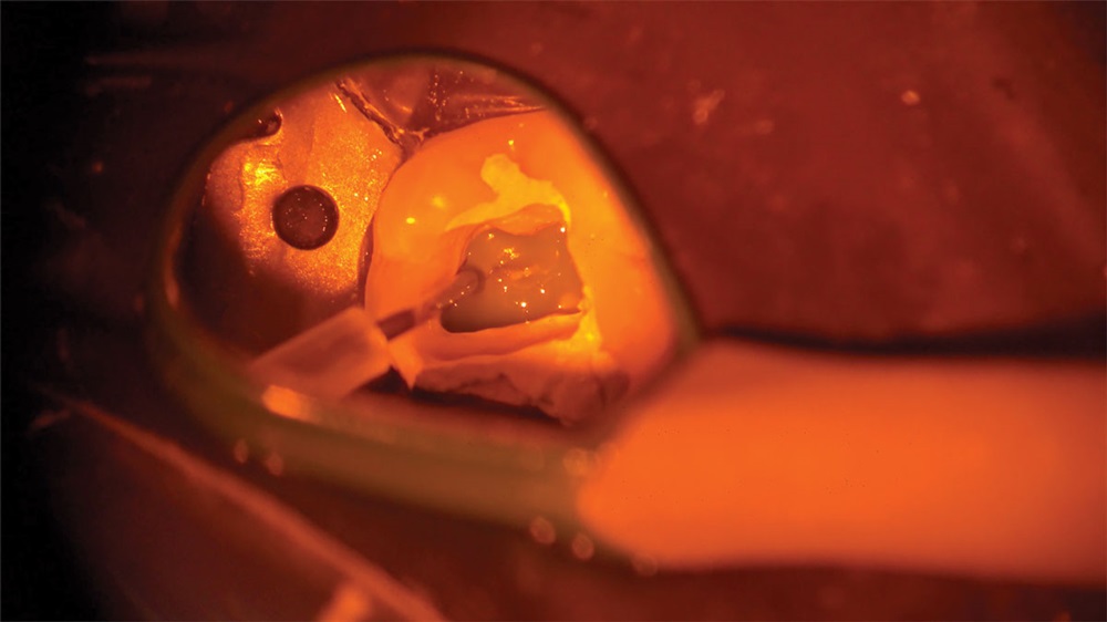 File Delivery for Endodontic Treatment