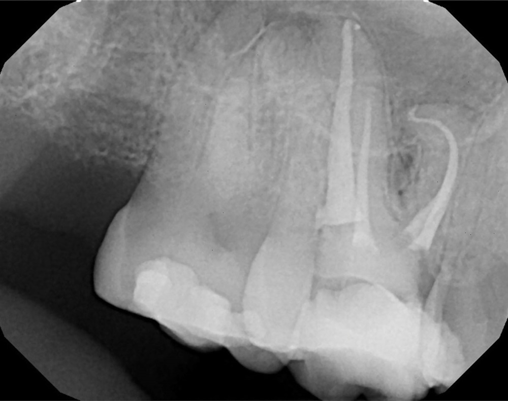 File Delivery for Endodontic Treatment