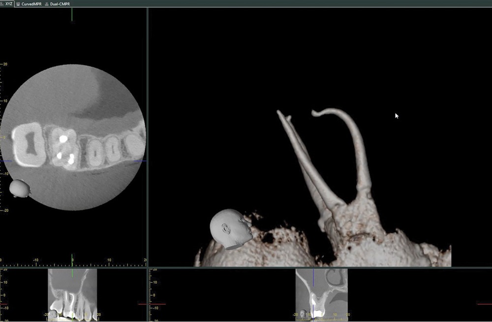 File Delivery for Endodontic Treatment