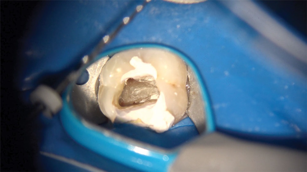 File Delivery for Endodontic Treatment