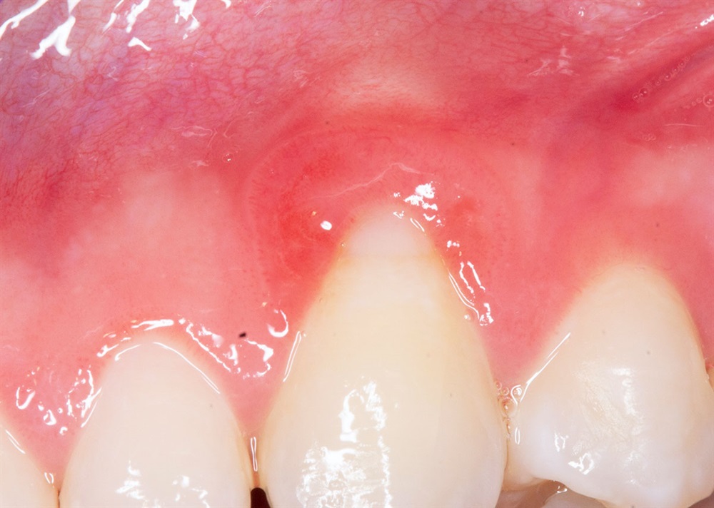 Autogenous Soft Tissue Grafting 