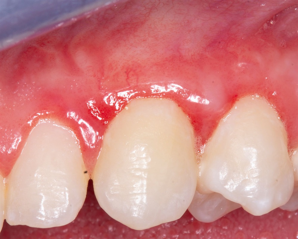 Autogenous Soft Tissue Grafting 