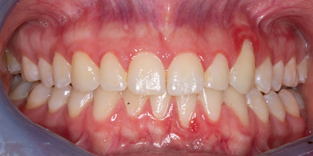 Autogenous Soft Tissue Grafting 