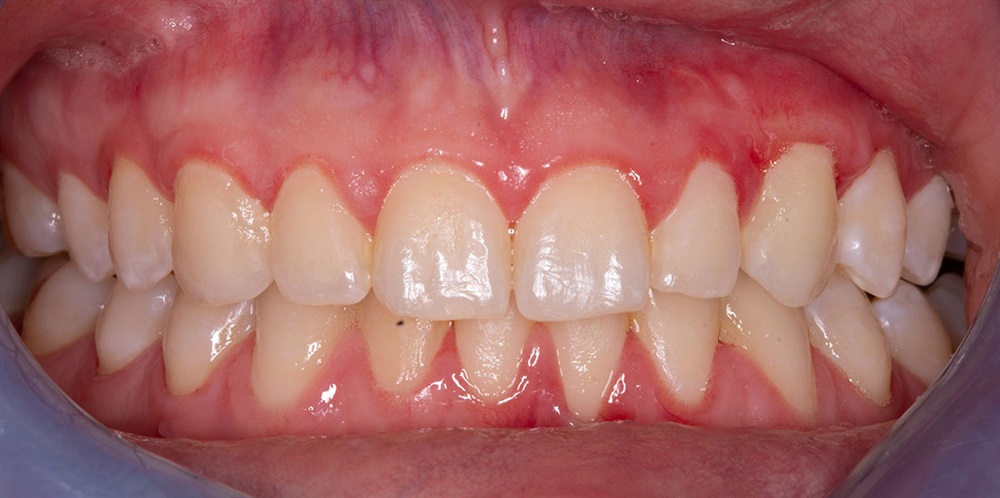 Autogenous Soft Tissue Grafting 