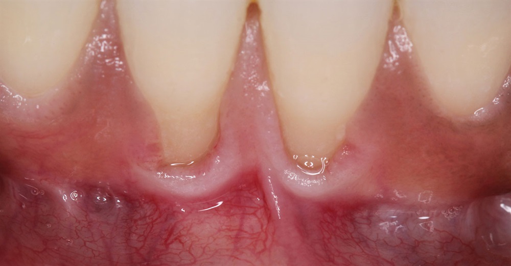 Autogenous Soft Tissue Grafting 