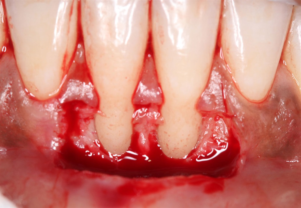 Autogenous Soft Tissue Grafting 