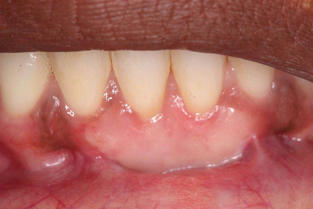 Autogenous Soft Tissue Grafting 
