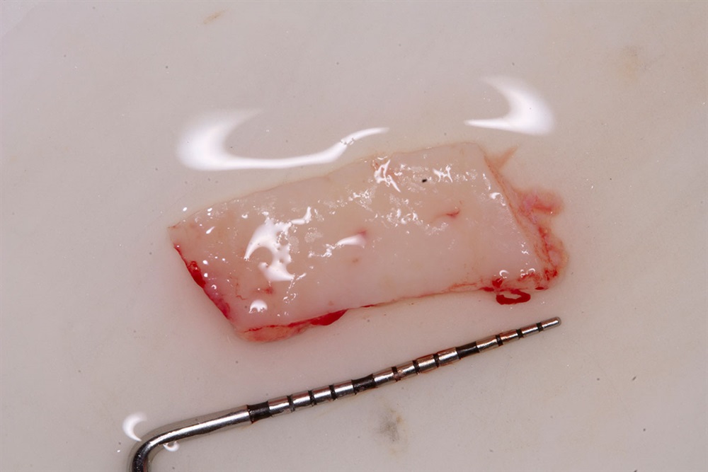 Autogenous Soft Tissue Grafting 