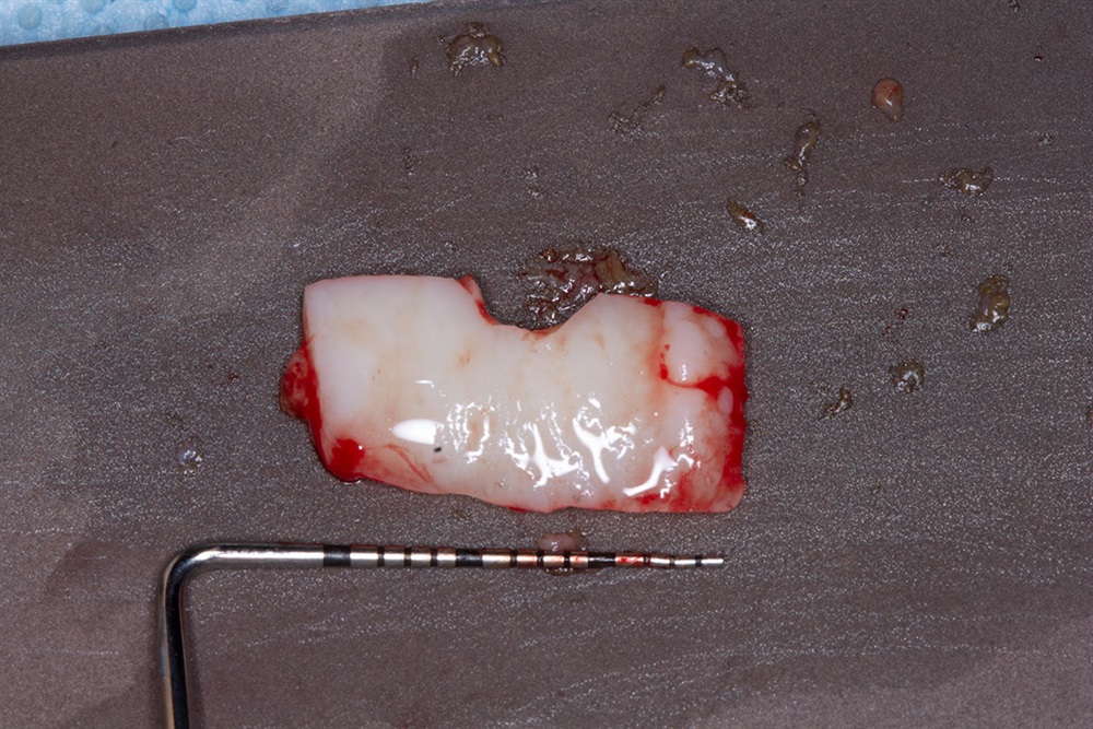 Autogenous Soft Tissue Grafting 