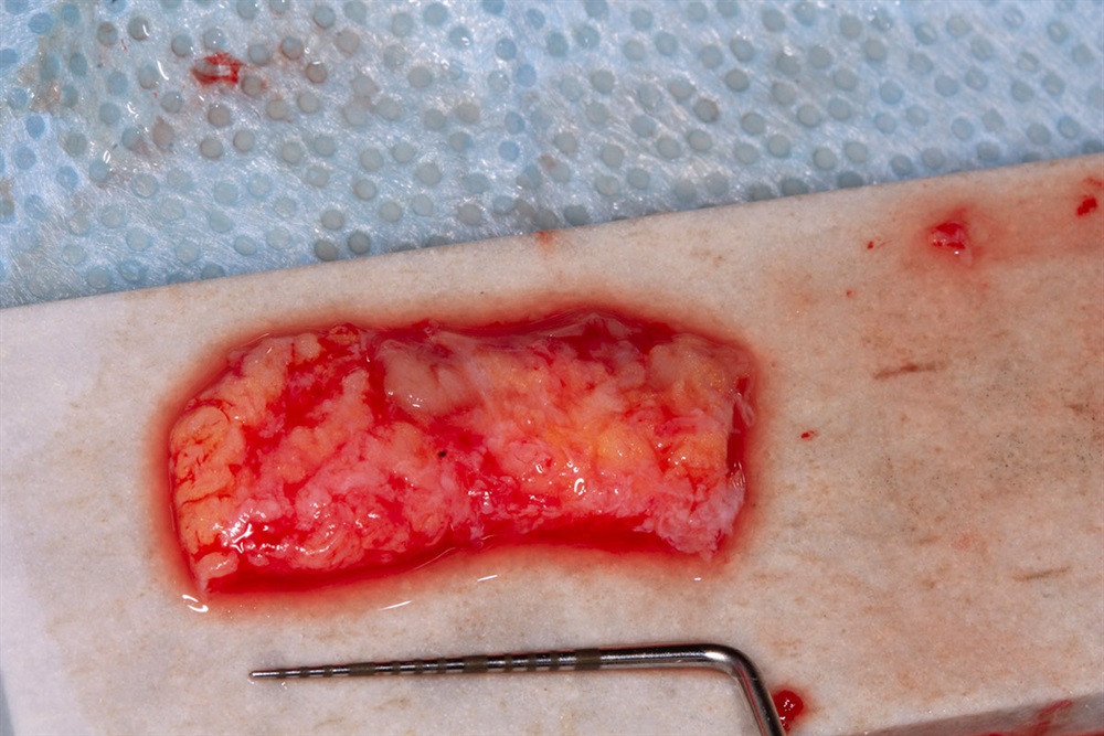 Autogenous Soft Tissue Grafting 