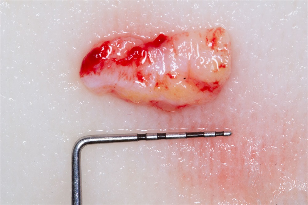 Autogenous Soft Tissue Grafting 