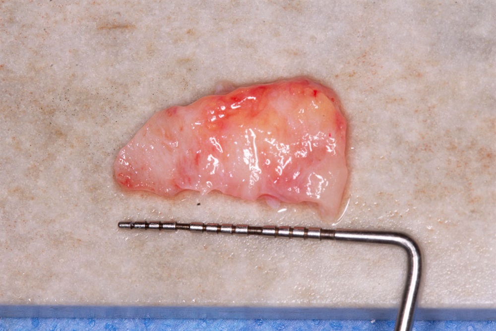 Autogenous Soft Tissue Grafting 