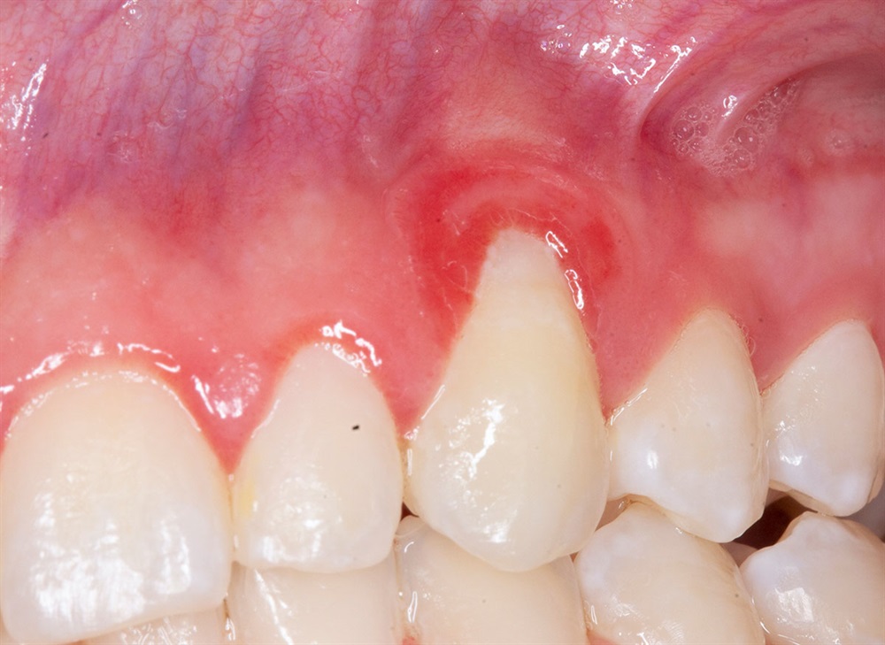 Autogenous Soft Tissue Grafting 