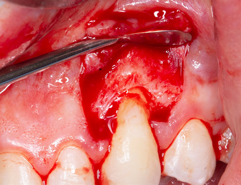 Autogenous Soft Tissue Grafting 