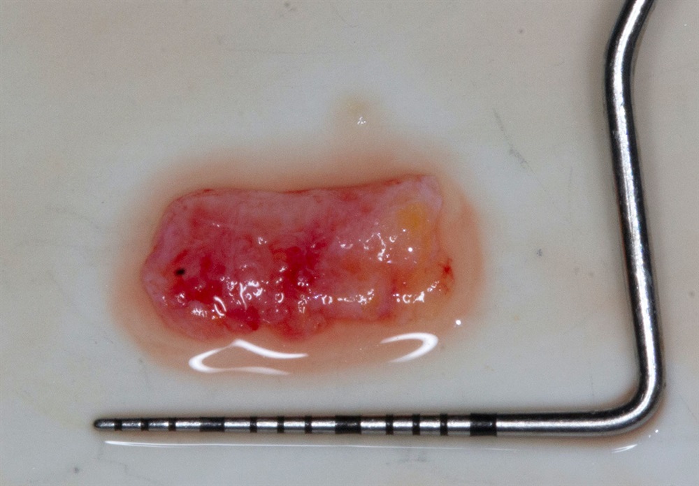 Autogenous Soft Tissue Grafting 