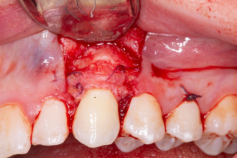 Autogenous Soft Tissue Grafting 