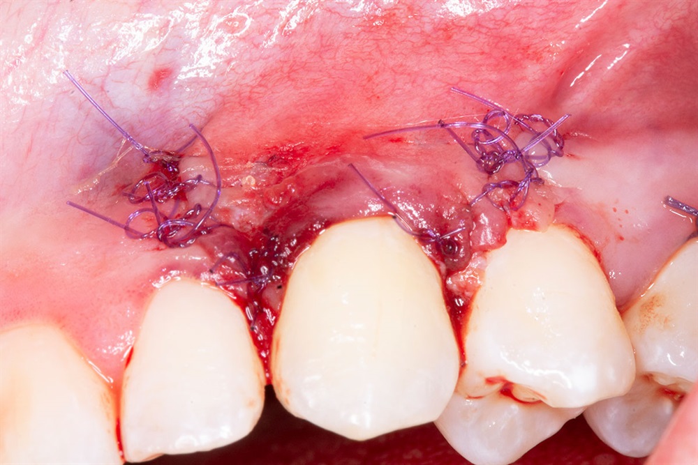 Autogenous Soft Tissue Grafting 