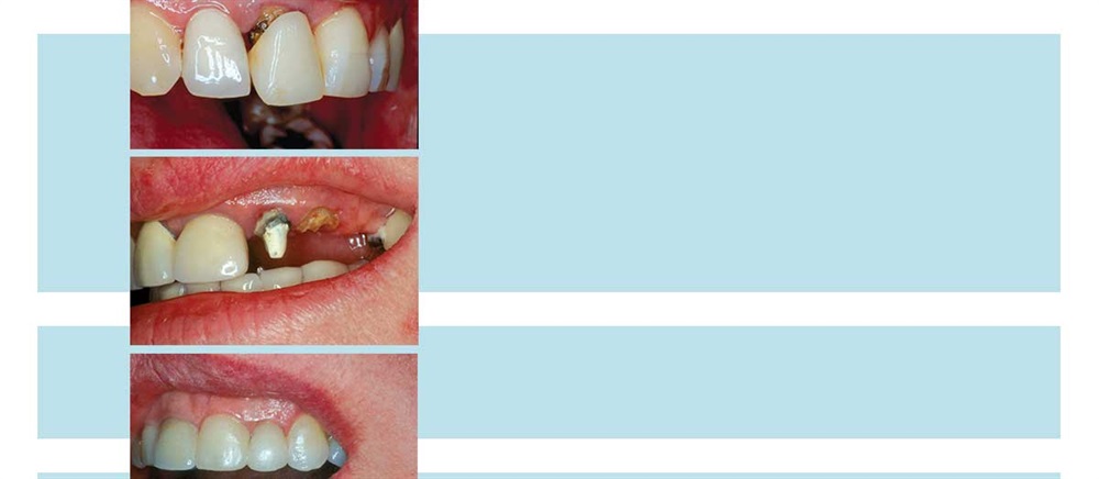 Erupting Compromised Teeth For Restoration