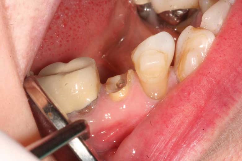 Erupting Compromised Teeth for Restoration by Dr. Joe Whitehouse ...