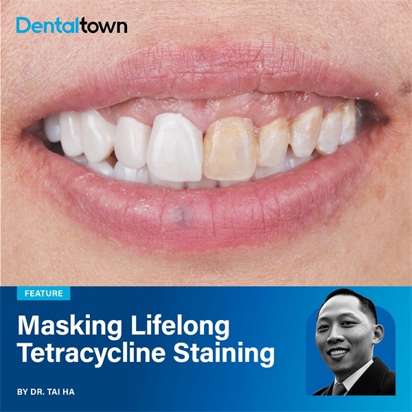 Masking Lifelong Tetracycline Staining