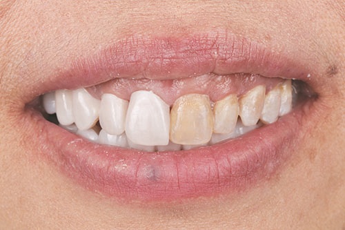 Masking Lifelong Tetracycline Staining