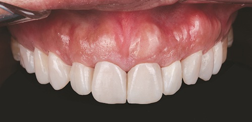 Masking Lifelong Tetracycline Staining