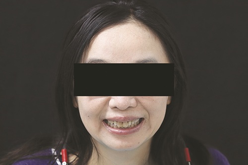 Masking Lifelong Tetracycline Staining