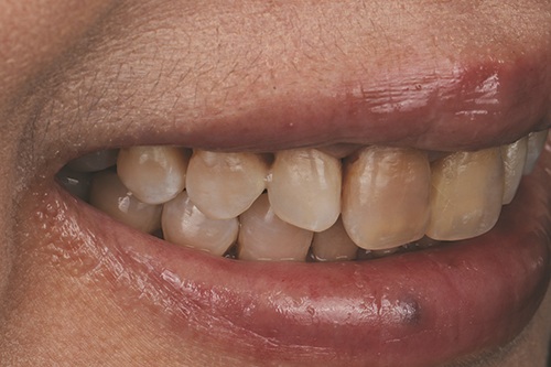 Masking Lifelong Tetracycline Staining