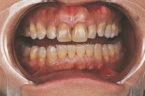 Masking Lifelong Tetracycline Staining
