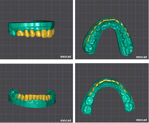 Masking Lifelong Tetracycline Staining