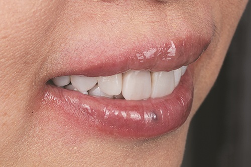 Masking Lifelong Tetracycline Staining