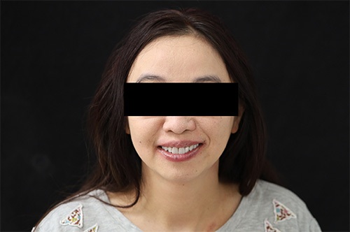 Masking Lifelong Tetracycline Staining