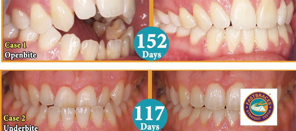 Product Profile: FastBraces