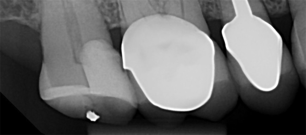 Clinical Case Spotlight: Using the Isolite Pro for a Difficult Posterior Restoration