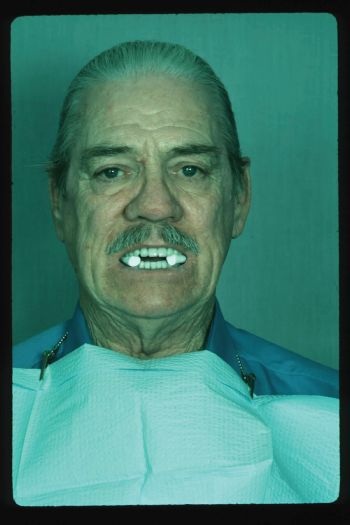 CE: Delivering Successful Complete Dentures