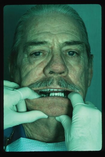 CE: Delivering Successful Complete Dentures