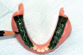 CE: Delivering Successful Complete Dentures