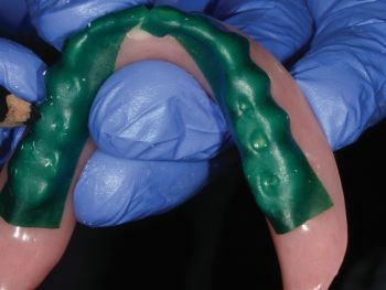 CE: Delivering Successful Complete Dentures