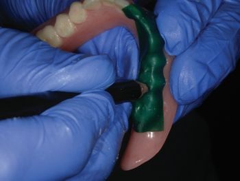 CE: Delivering Successful Complete Dentures