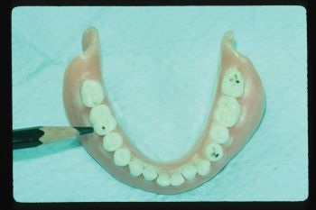 CE: Delivering Successful Complete Dentures