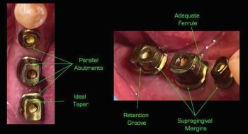A Screwmentable Approach for Predictable Posterior Implant Restoration