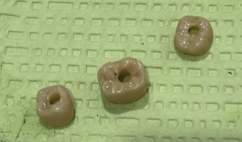 A Screwmentable Approach for Predictable Posterior Implant Restoration