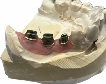 A Screwmentable Approach for Predictable Posterior Implant Restoration