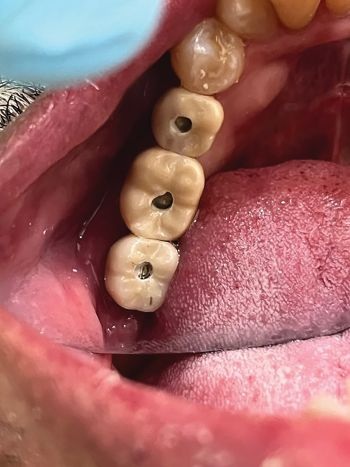 A Screwmentable Approach for Predictable Posterior Implant Restoration