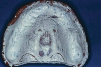 CE: Delivering Successful Complete Dentures