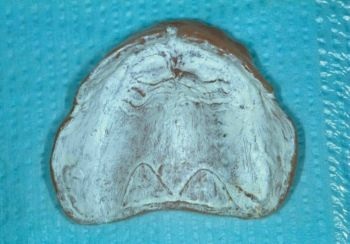 CE: Delivering Successful Complete Dentures