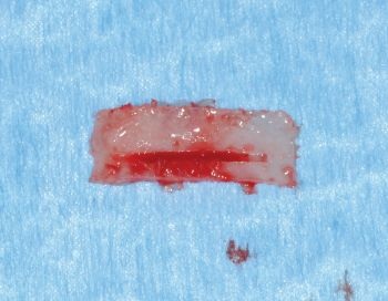 When Implants Go Rogue