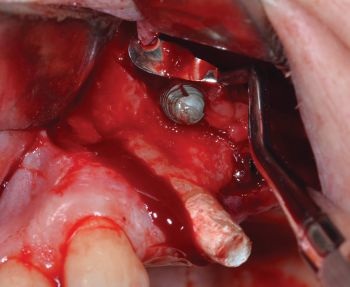 When Implants Go Rogue