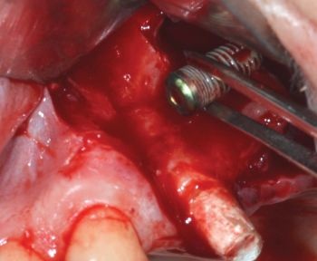 When Implants Go Rogue